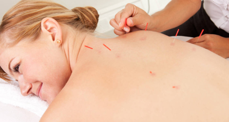 Acupuncture Treatment Brampton