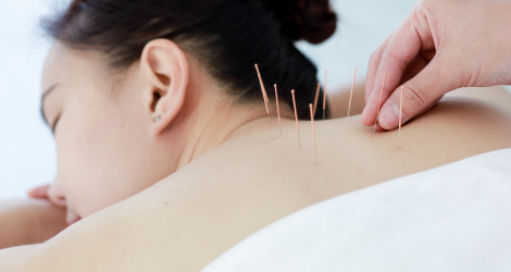 Discover the Healing Power of Acupuncture Treatment in Brampton at Sandalwood Physio