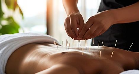 Acupuncture