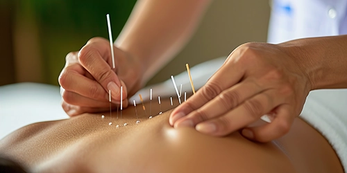 Acupuncture